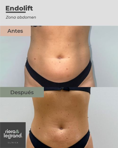 Endolift abdomen. Antes y Despu&eacute;s
