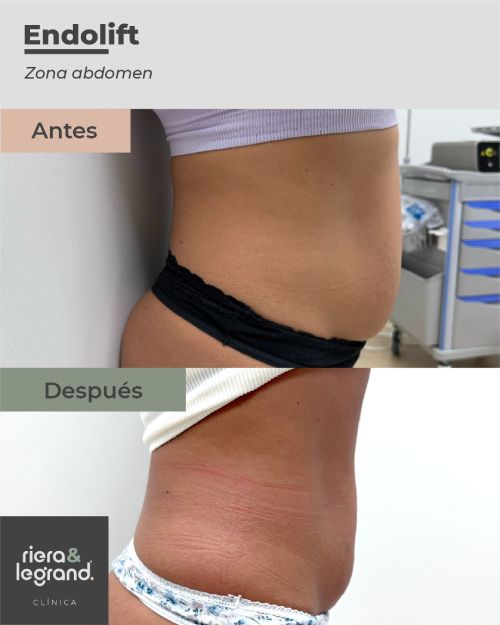 Endolift abdominal. Antes y Despu&eacute;s