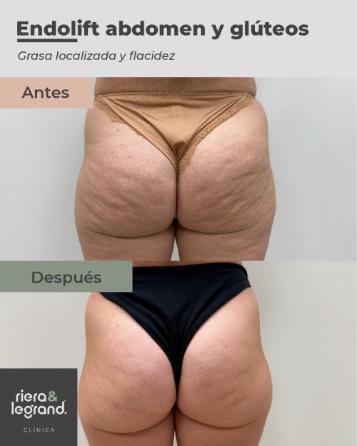 Endolift gl&uacute;teos. Antes y Despu&eacute;s