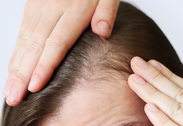 por qué se me cae el cabello